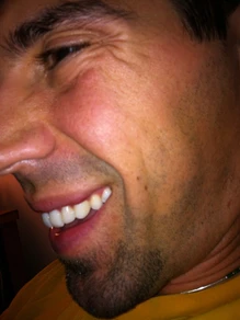 "It Started with a Chip" How Porcelain Veneers Ruined My Smile for 21 Years Until Dr. Jordan Davis Changed Everything 9 5cc9db aec963f032c74cc98ceaa60103de1b4bmv2
