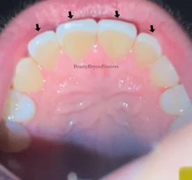 Mastering the Art of Aesthetics: Composite vs Porcelain Veneers: The Case for Composite Veneers 3 porcelain veneers back of teeth