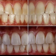 Mastering the Art of Aesthetics: Composite vs Porcelain Veneers: The Case for Composite Veneers 13 composite resin veneers