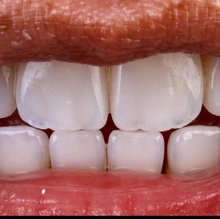 Mastering the Art of Aesthetics: Composite vs Porcelain Veneers: The Case for Composite Veneers 12 composite resin veneers