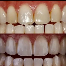 Mastering the Art of Aesthetics: Composite vs Porcelain Veneers: The Case for Composite Veneers 11 composite resin veneers