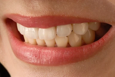 Mastering the Art of Aesthetics: Composite vs Porcelain Veneers: The Case for Composite Veneers 4 porcelain veneers on teeth